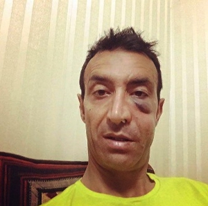 گونه و فک عنایتی شکست