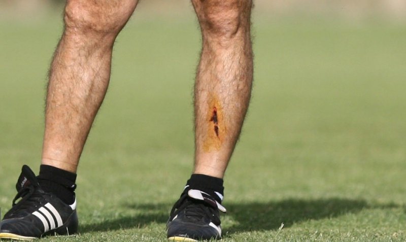 راز زخم عمیق روی ساق پای ساپینتو (عکس)