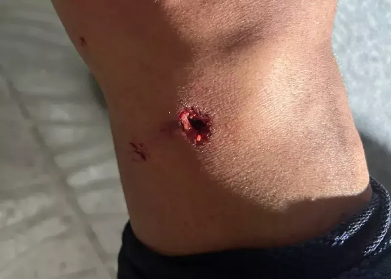 تصویر ترسناک از زانوی سوراخ شده بازیکن آلومینیوم!