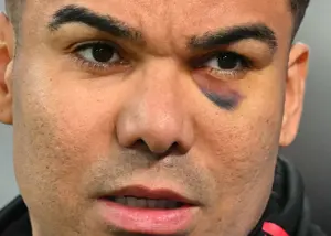 کاسمیرو با چشم کبود هواداران را شوکه کرد!