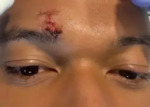 بدون شرح با سه بخیه: زخم امباپه به رنگ خون!